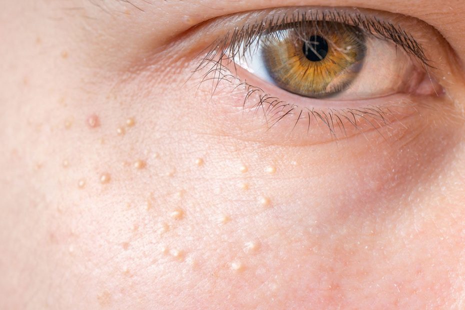 去除油脂粒方法